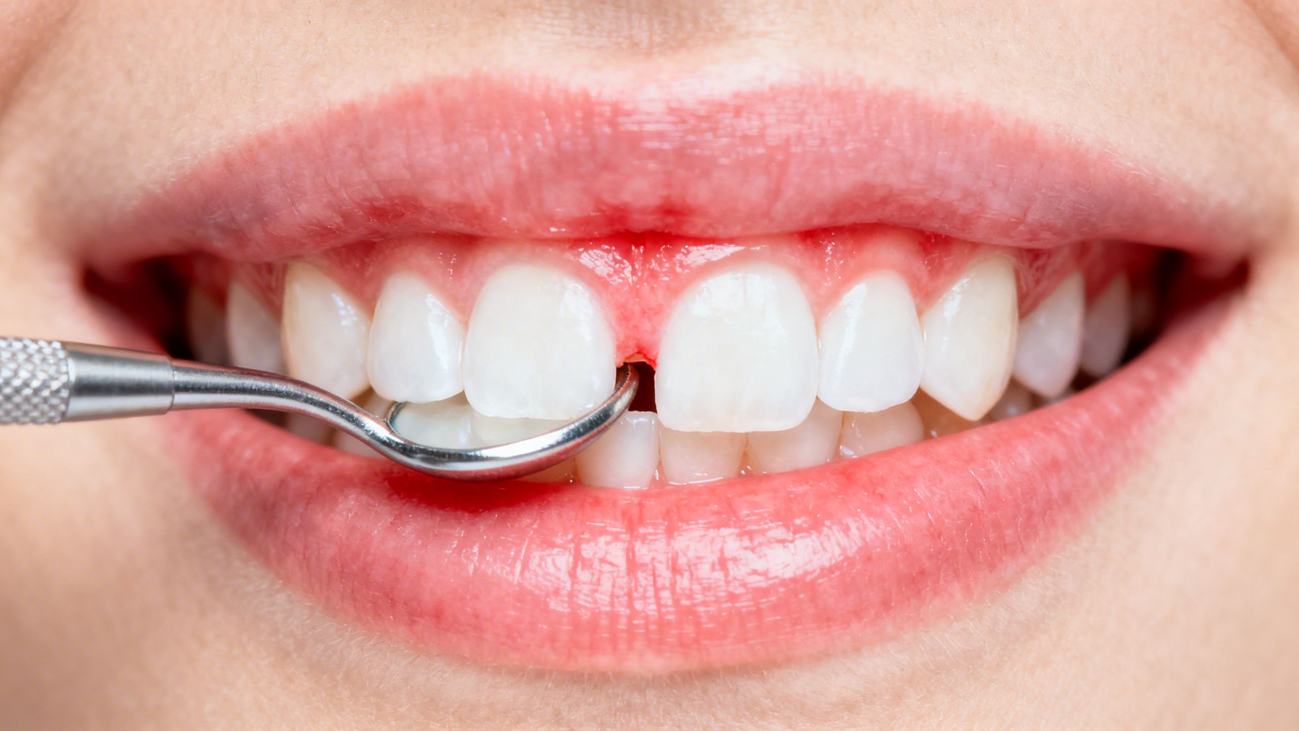 Understanding Periodontitis: Causes, Symptoms, and Effective Treatment Options