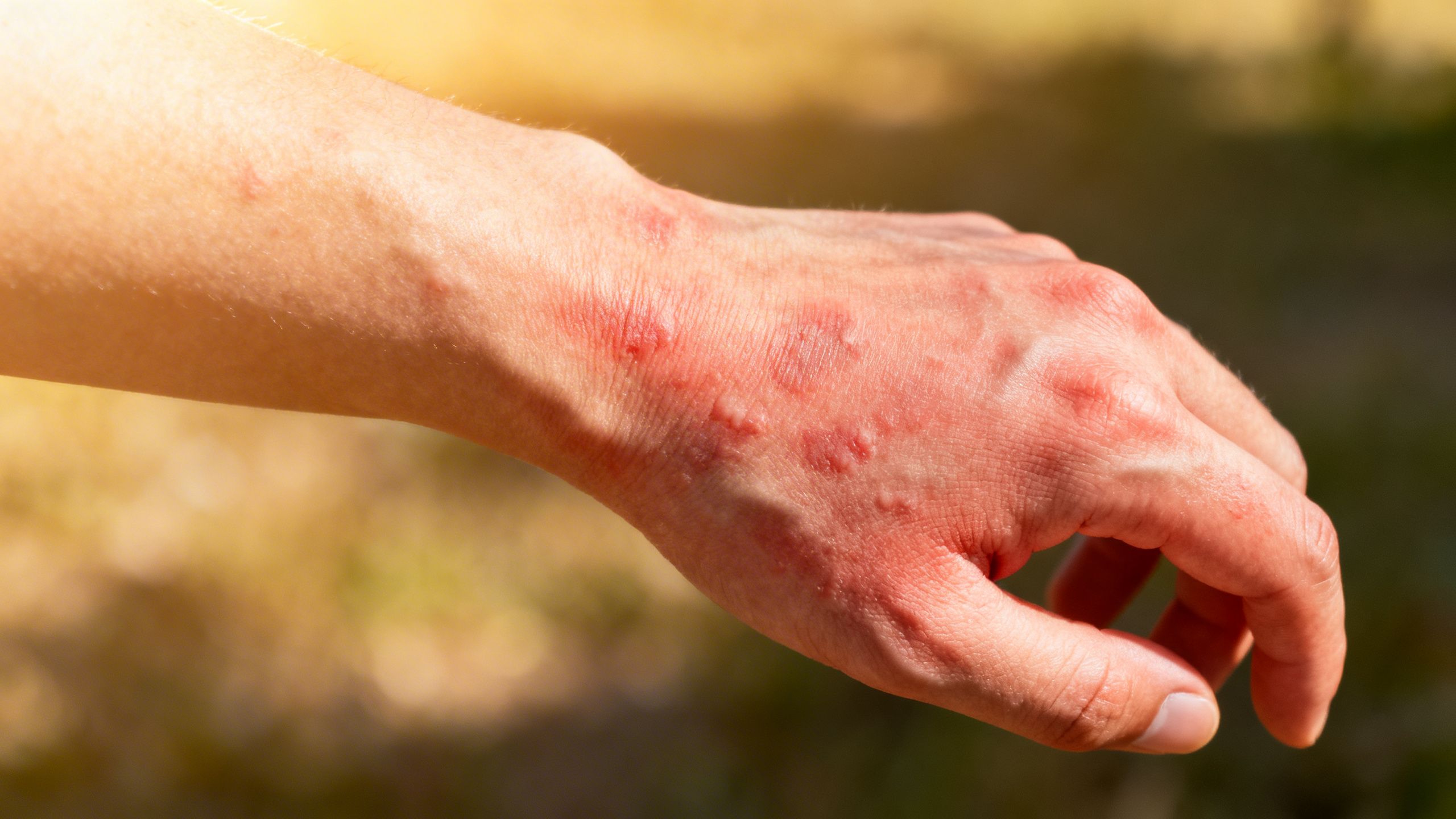 Urticaria: What’s That Rash?